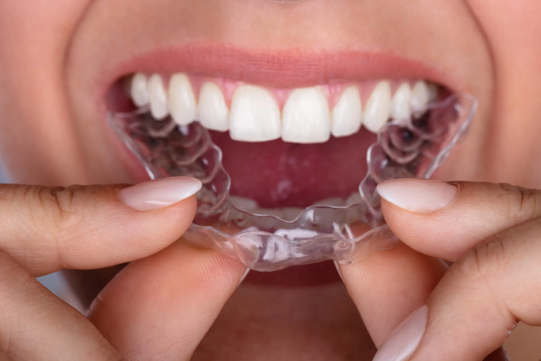 Aligners